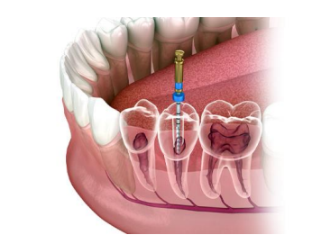 Root Canal Treatment: Everything You Should Know